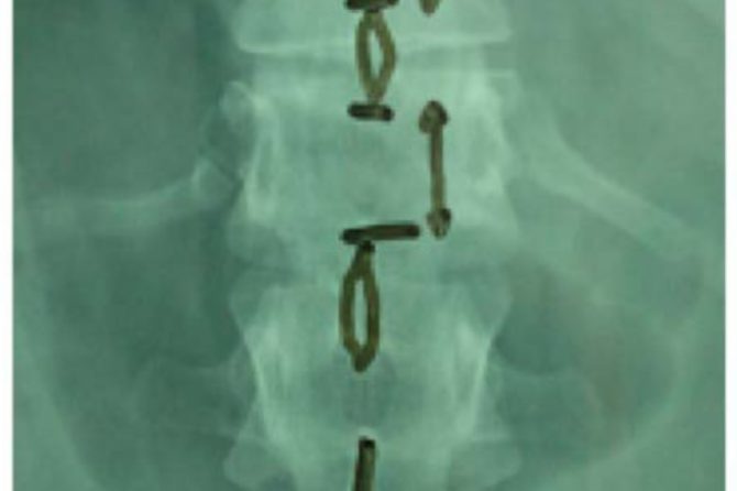 Anteroposterior (AP) radiograph demonstrating increased interspinous distance at the level of injury.