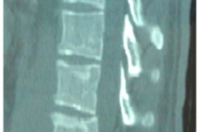 CT scan - sagittal plane, demonstrating the same T12 fracture shown in the radiographs.