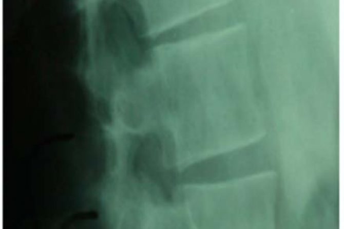 Lateral radiograph demonstrating a T12 transverse fracture.